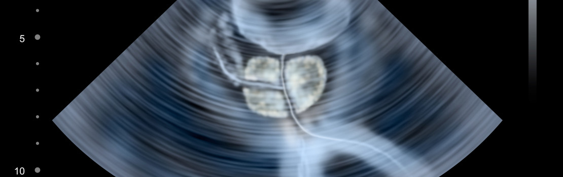 problemy-s-prostatou