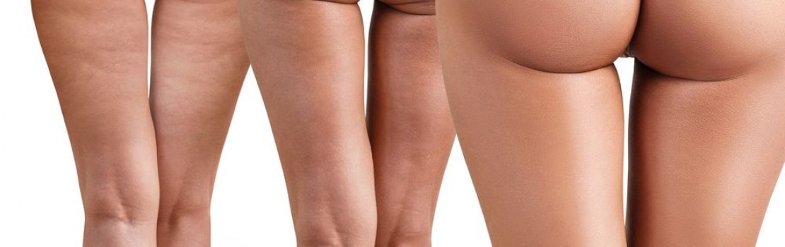 Celulitída. Vieme čo si o nej myslia muži